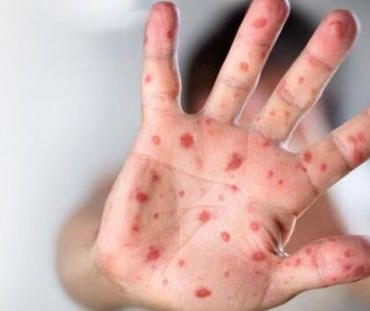 el, ayak ve ağız hastalığı