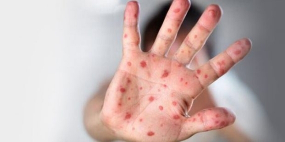 el, ayak ve ağız hastalığı